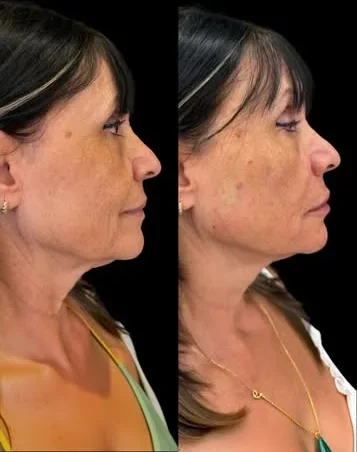 Antes e depois de harmonização de contorno facial, paciente real