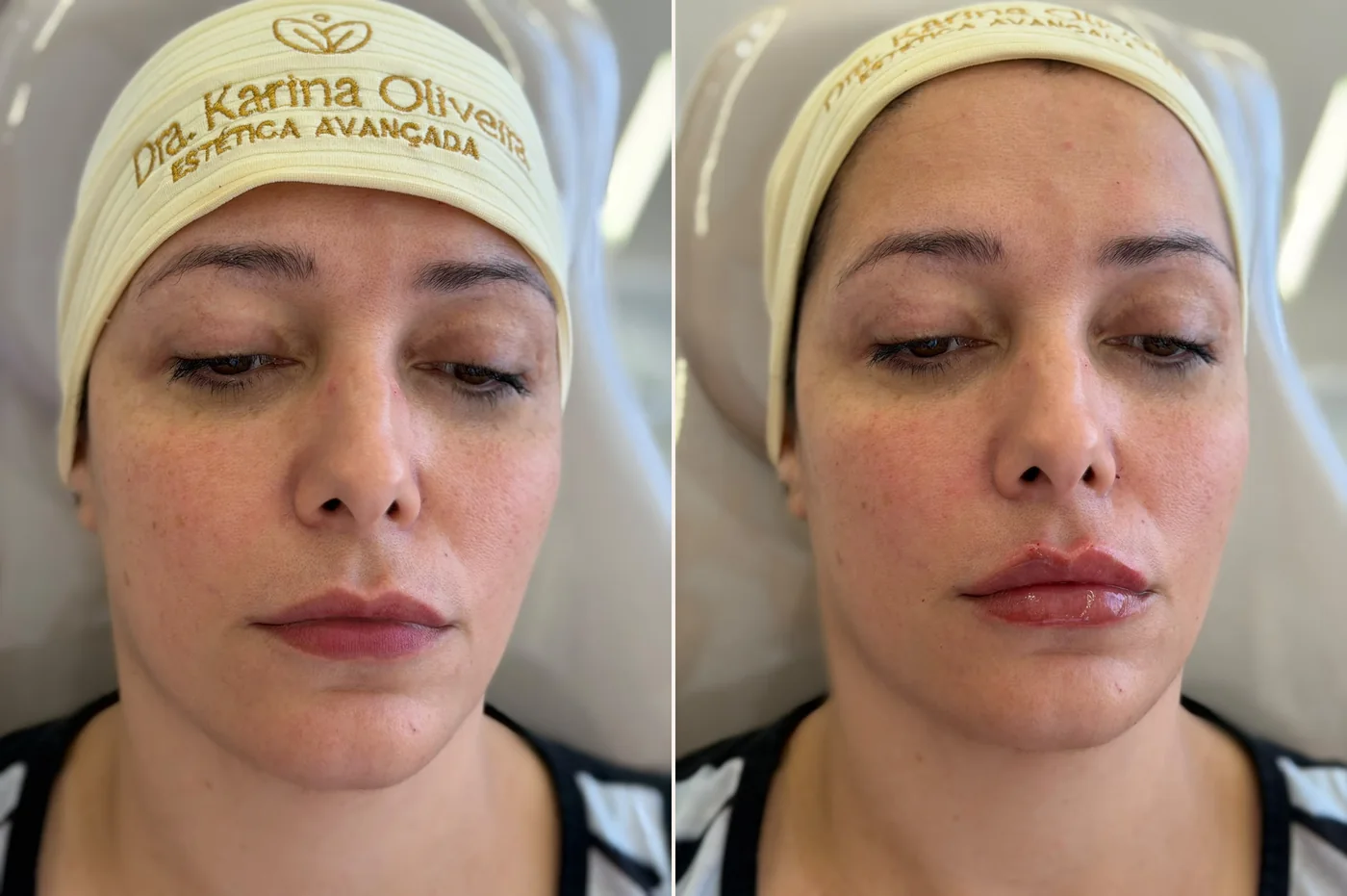 Antes e depois de preenchimento labial, vista frontal, paciente real da Dra. Karina Oliveira