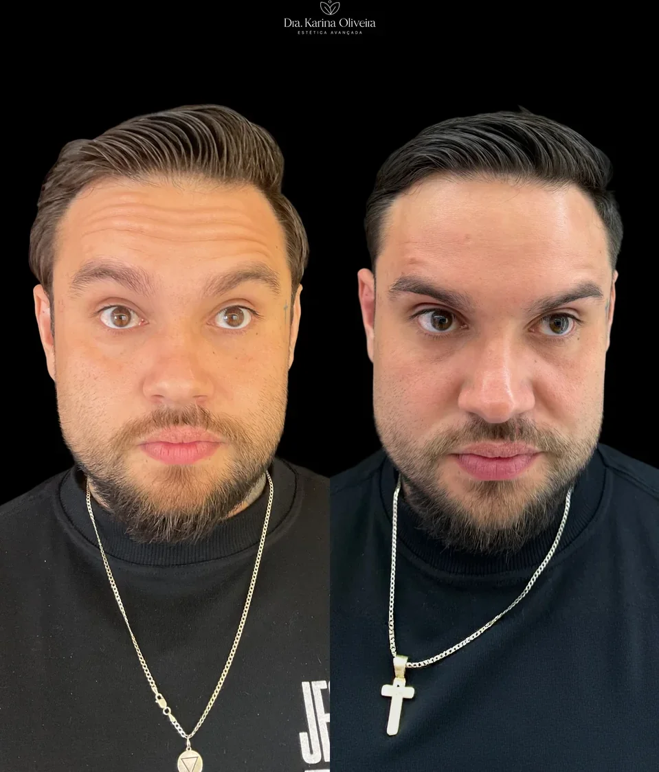 Antes e depois de harmonização facial masculina, paciente real